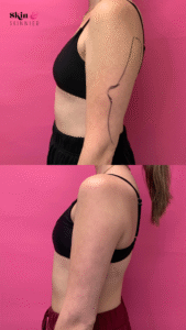 Arm Lipo