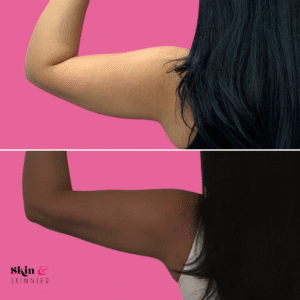 Arm Liposuction