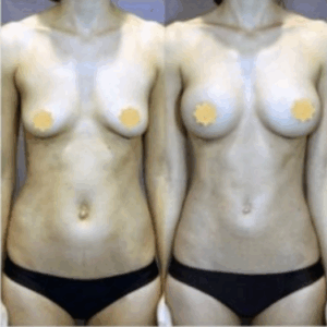 Fat transfer to the breasts